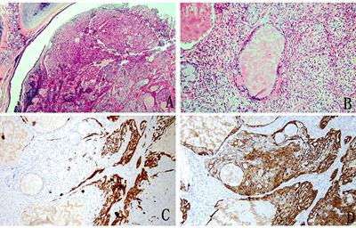 Pulmonary mucoepidermoid carcinoma in the Chinese population: A clinical characteristic and prognostic analysis
